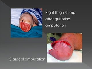 Right thigh stump
after guillotine
amputation
Classical amputation
 