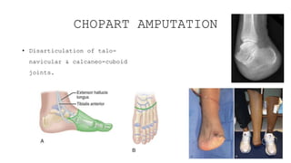 Amputation Topic Orthopaedics Presentation | PPTX