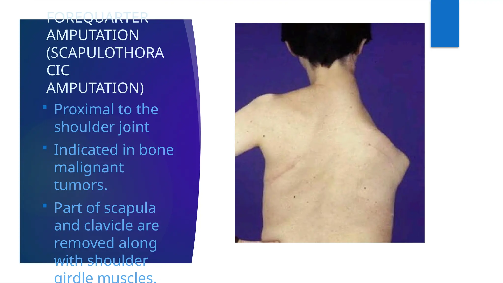 FOREQUARTER
AMPUTATION
(SCAPULOTHORA
CIC
AMPUTATION)
 Proximal to the
shoulder joint
 Indicated in bone
malignant
tumors.
 Part of scapula
and clavicle are
removed along
with shoulder
 