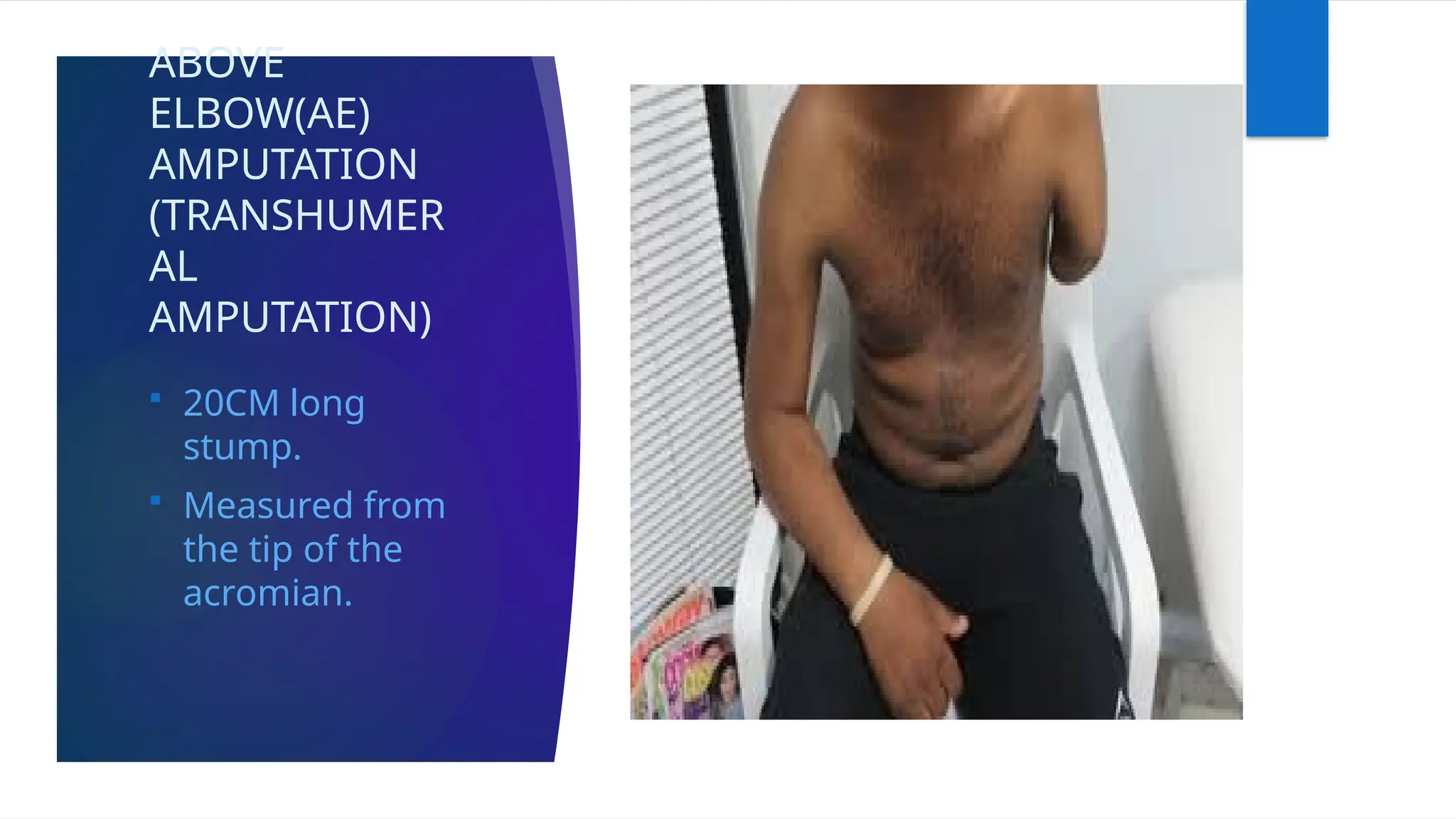 ABOVE
ELBOW(AE)
AMPUTATION
(TRANSHUMER
AL
AMPUTATION)
 20CM long
stump.
 Measured from
the tip of the
acromian.
 