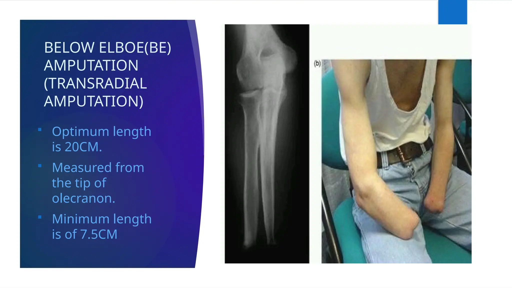 BELOW ELBOE(BE)
AMPUTATION
(TRANSRADIAL
AMPUTATION)
 Optimum length
is 20CM.
 Measured from
the tip of
olecranon.
 Minimum length
is of 7.5CM
 