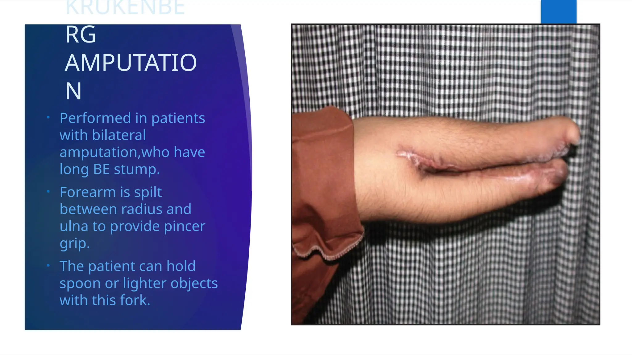 KRUKENBE
RG
AMPUTATIO
N
• Performed in patients
with bilateral
amputation,who have
long BE stump.
• Forearm is spilt
between radius and
ulna to provide pincer
grip.
• The patient can hold
spoon or lighter objects
with this fork.
 