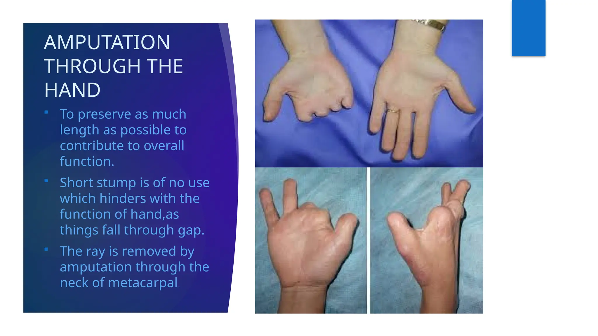 AMPUTATION
THROUGH THE
HAND
 To preserve as much
length as possible to
contribute to overall
function.
 Short stump is of no use
which hinders with the
function of hand,as
things fall through gap.
 The ray is removed by
amputation through the
neck of metacarpal.
 