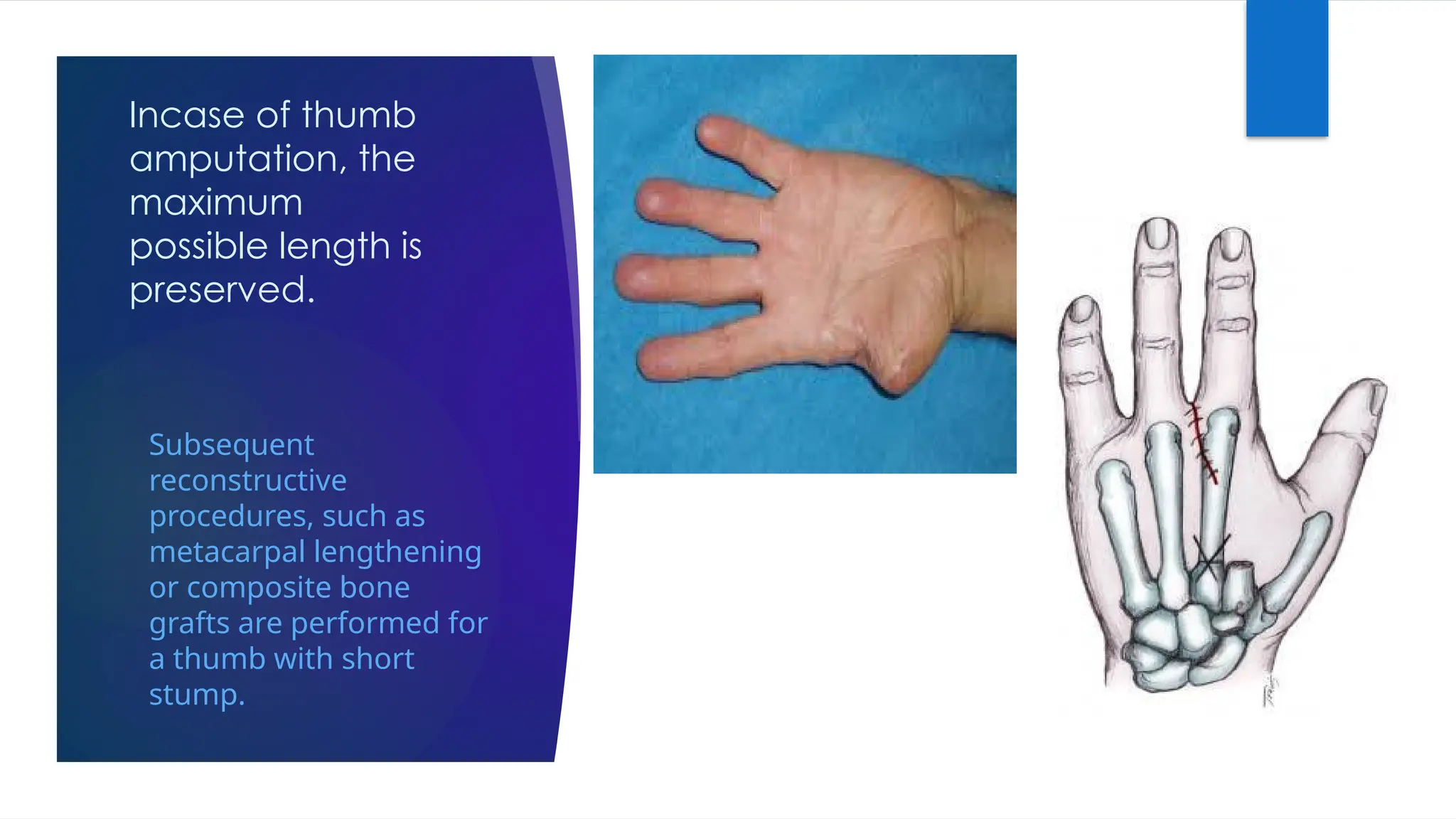 Incase of thumb
amputation, the
maximum
possible length is
preserved.
Subsequent
reconstructive
procedures, such as
metacarpal lengthening
or composite bone
grafts are performed for
a thumb with short
stump.
 