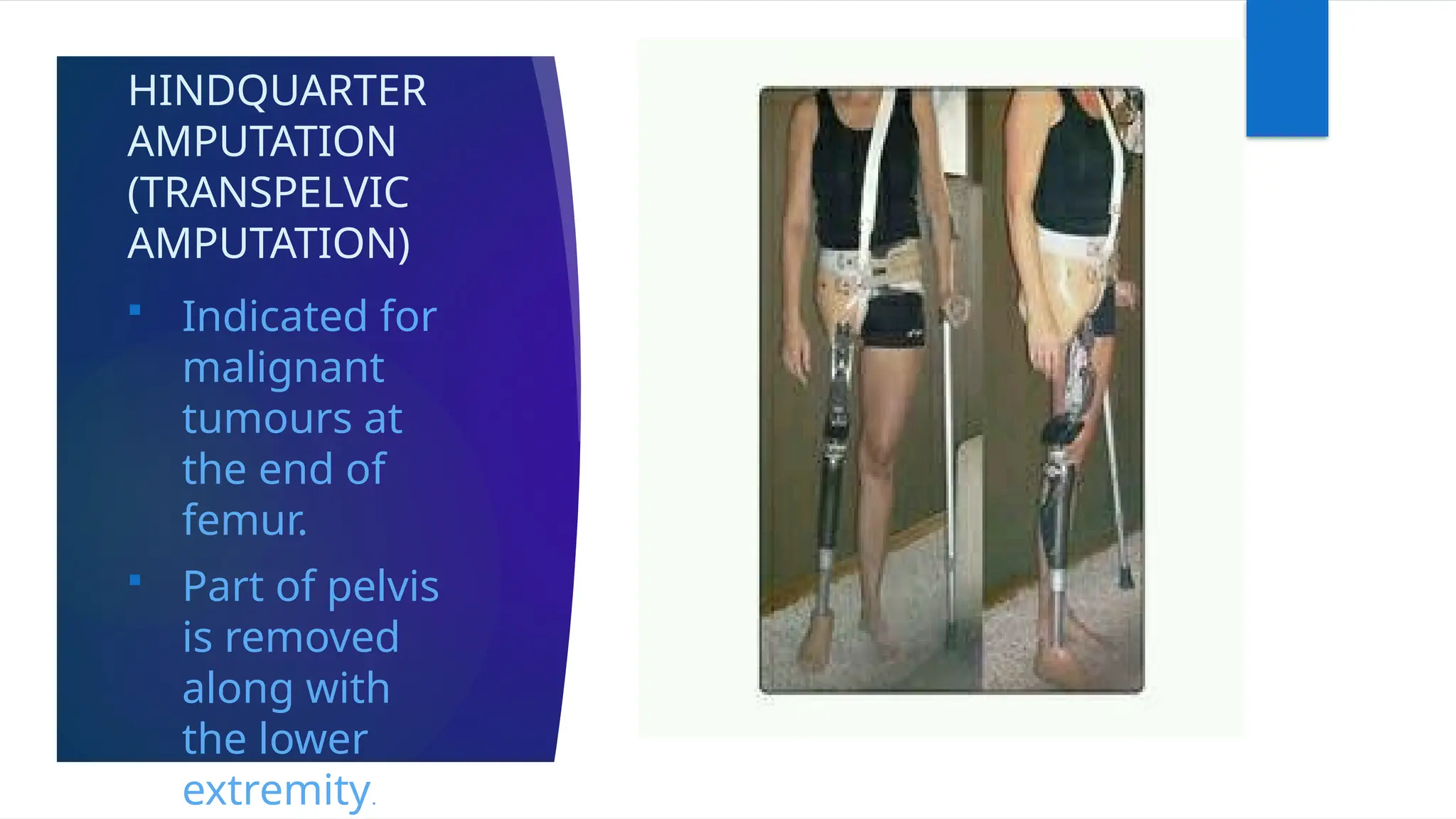 HINDQUARTER
AMPUTATION
(TRANSPELVIC
AMPUTATION)
 Indicated for
malignant
tumours at
the end of
femur.
 Part of pelvis
is removed
along with
the lower
extremity.
 
