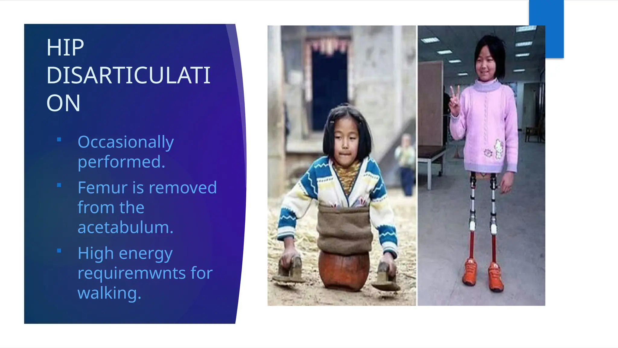 HIP
DISARTICULATI
ON
 Occasionally
performed.
 Femur is removed
from the
acetabulum.
 High energy
requiremwnts for
walking.
 