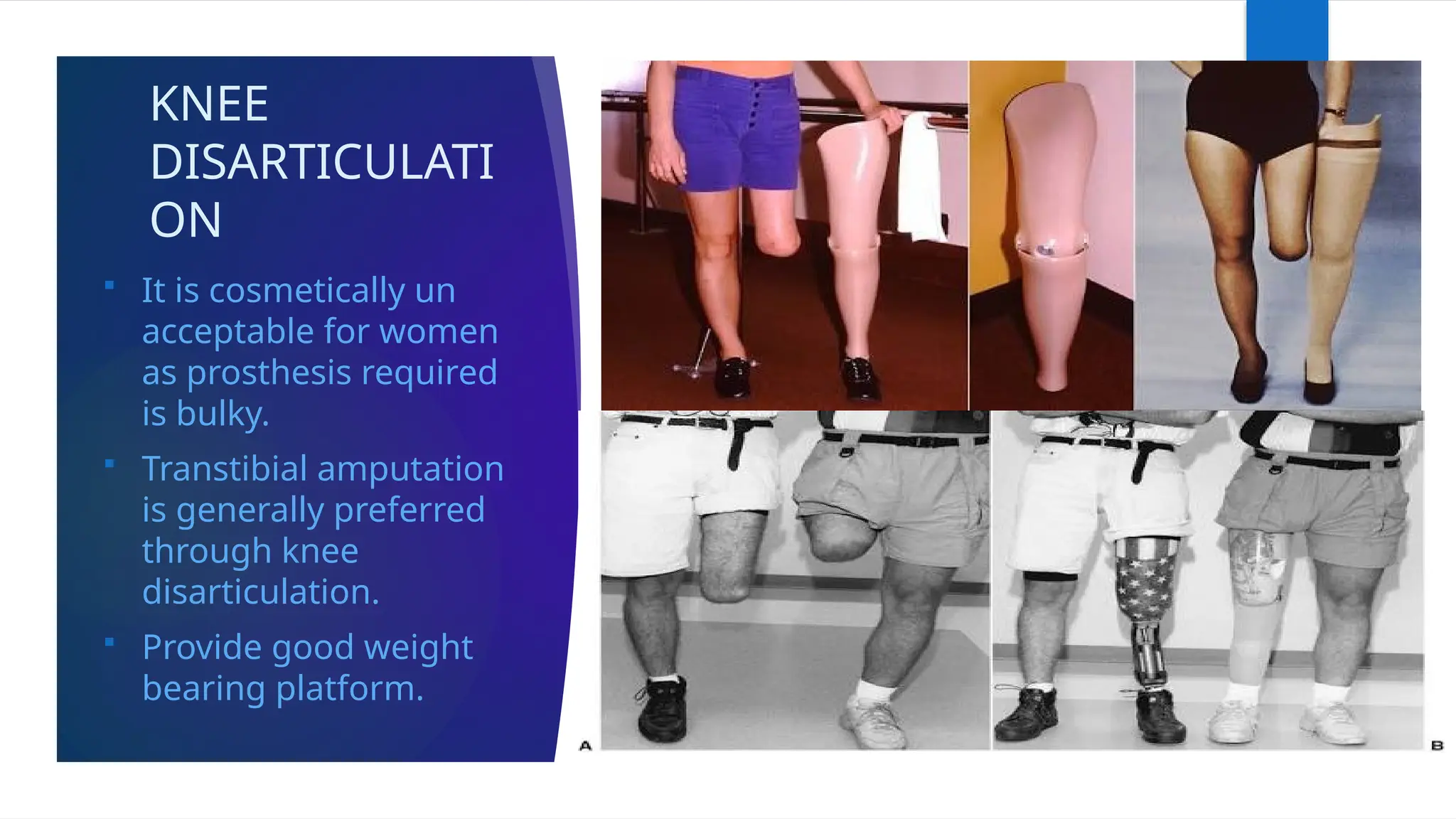 KNEE
DISARTICULATI
ON
 It is cosmetically un
acceptable for women
as prosthesis required
is bulky.
 Transtibial amputation
is generally preferred
through knee
disarticulation.
 Provide good weight
bearing platform.
 