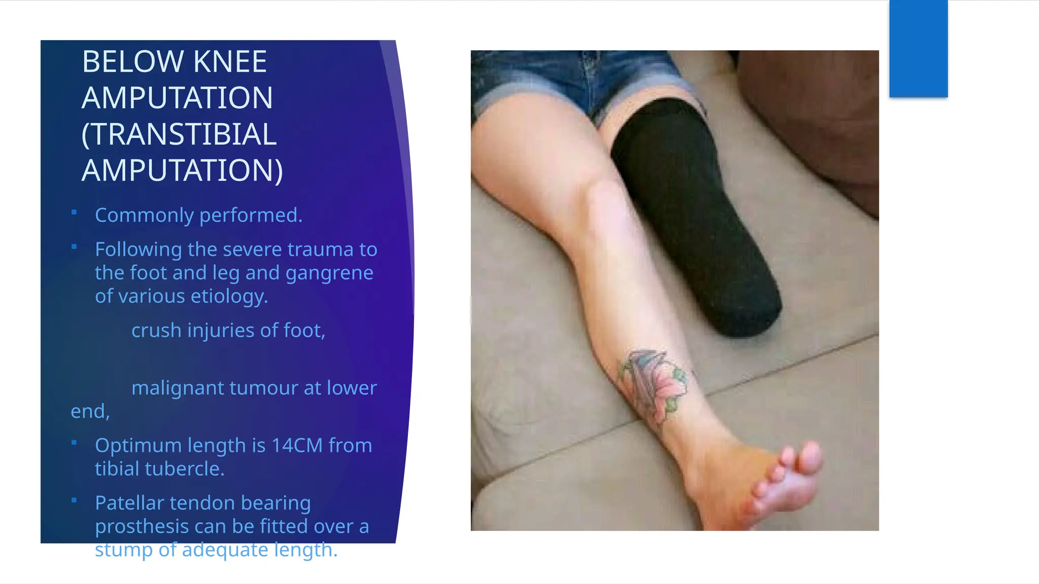 BELOW KNEE
AMPUTATION
(TRANSTIBIAL
AMPUTATION)
 Commonly performed.
 Following the severe trauma to
the foot and leg and gangrene
of various etiology.
crush injuries of foot,
malignant tumour at lower
end,
 Optimum length is 14CM from
tibial tubercle.
 Patellar tendon bearing
prosthesis can be fitted over a
stump of adequate length.
 