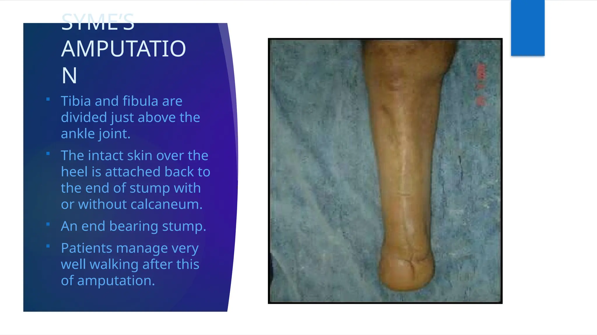 SYME’S
AMPUTATIO
N
 Tibia and fibula are
divided just above the
ankle joint.
 The intact skin over the
heel is attached back to
the end of stump with
or without calcaneum.
 An end bearing stump.
 Patients manage very
well walking after this
of amputation.
 