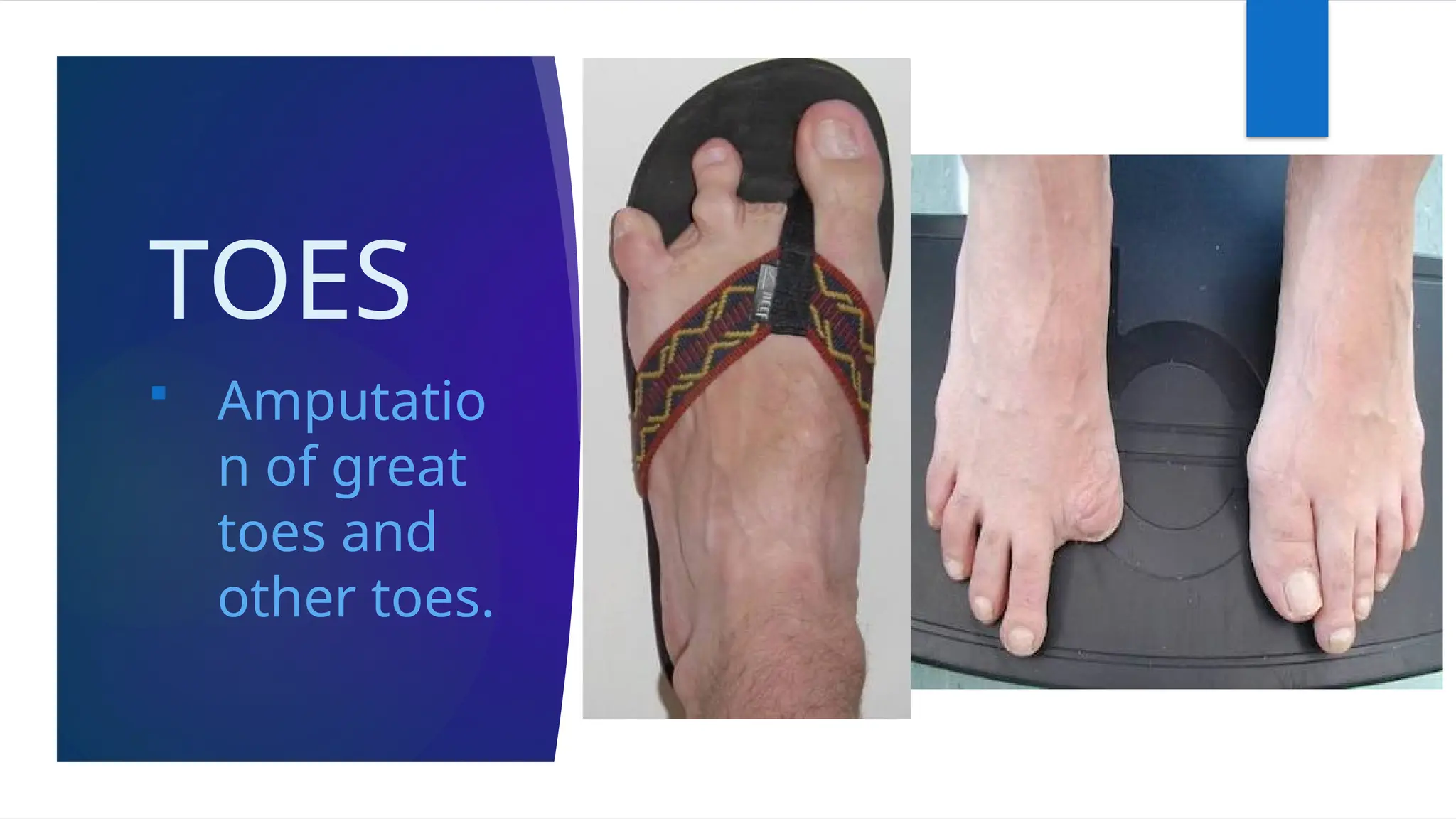 TOES
 Amputatio
n of great
toes and
other toes.
 