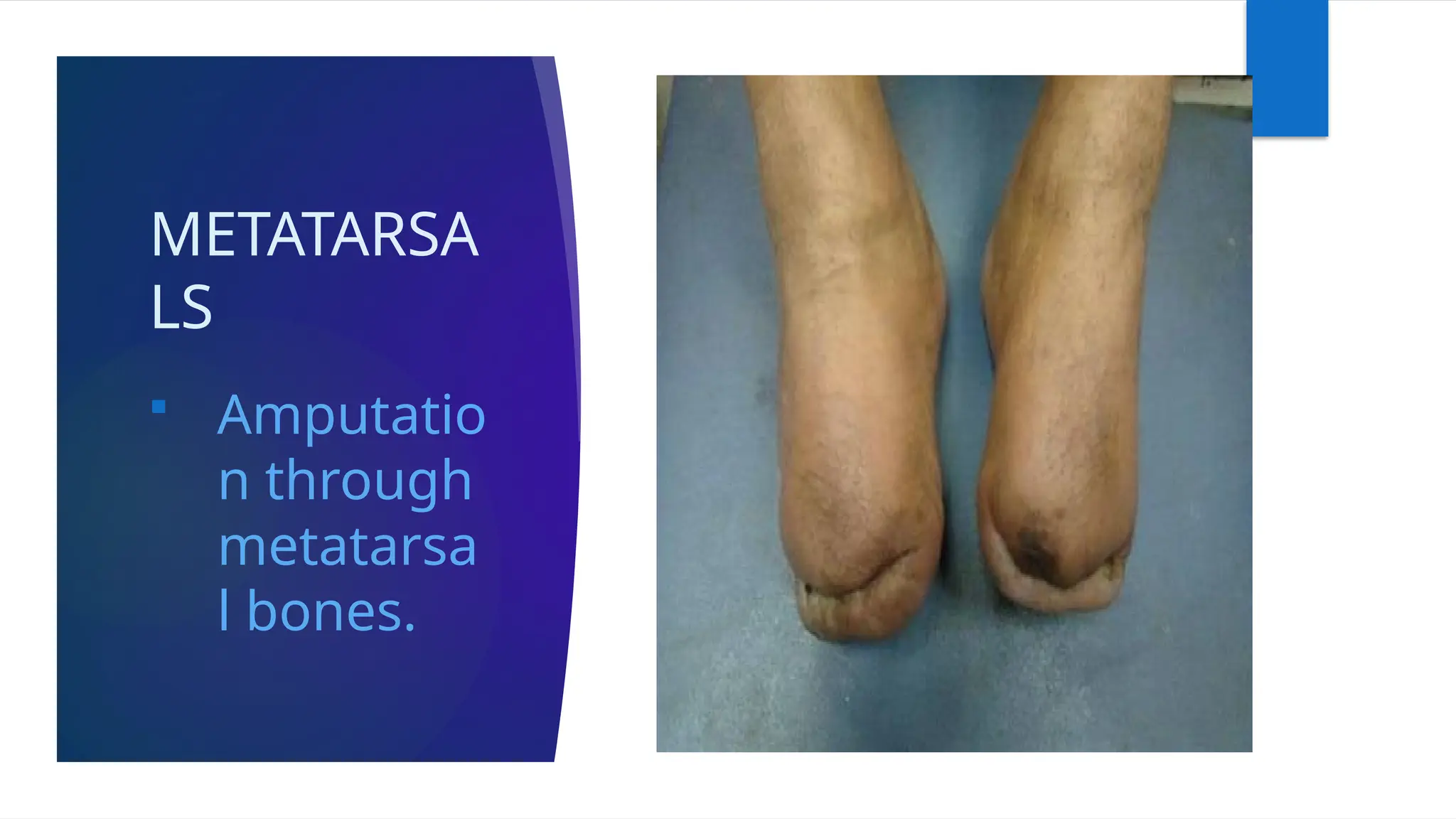 METATARSA
LS
 Amputatio
n through
metatarsa
l bones.
 