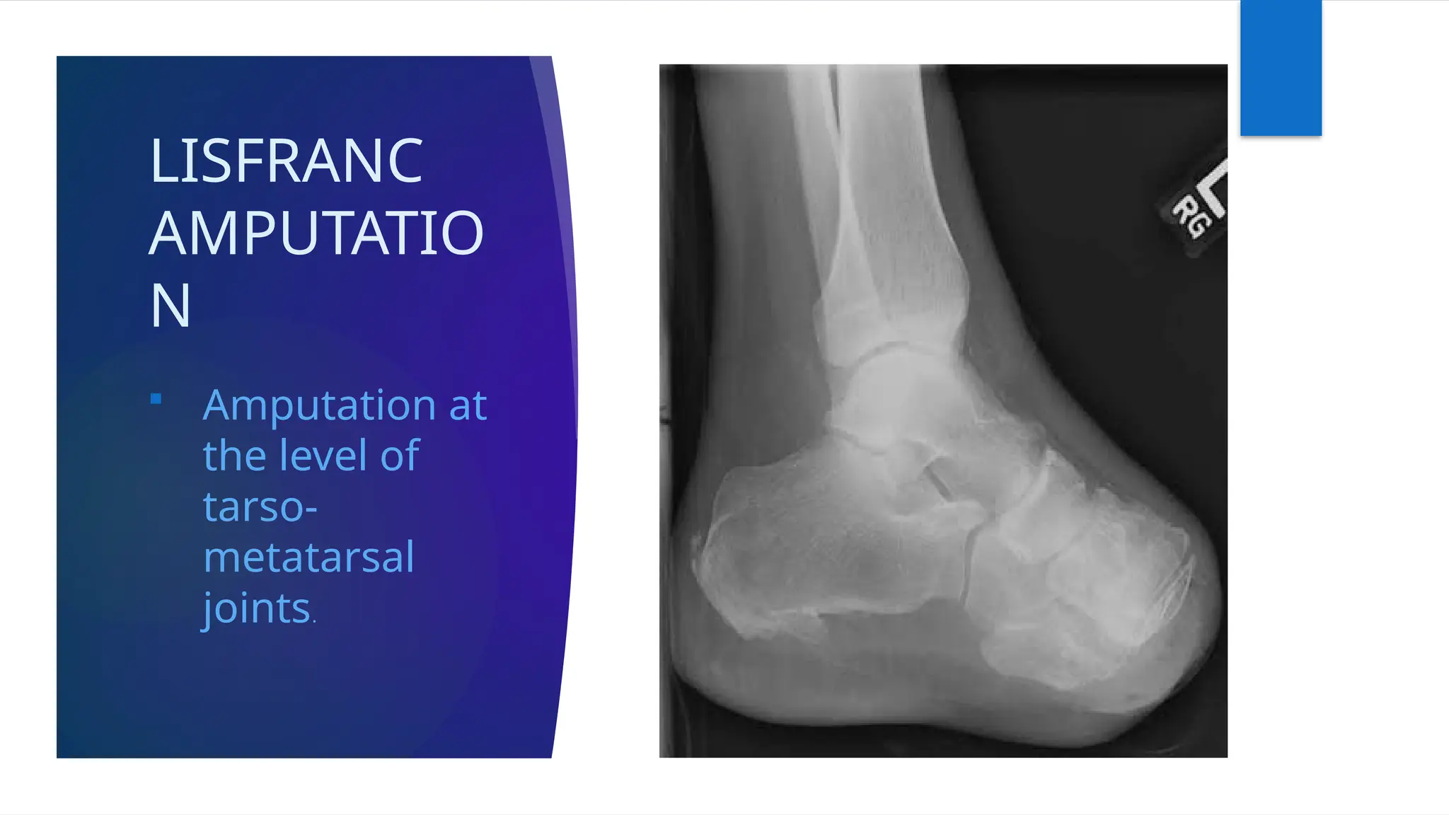 LISFRANC
AMPUTATIO
N
 Amputation at
the level of
tarso-
metatarsal
joints.
 