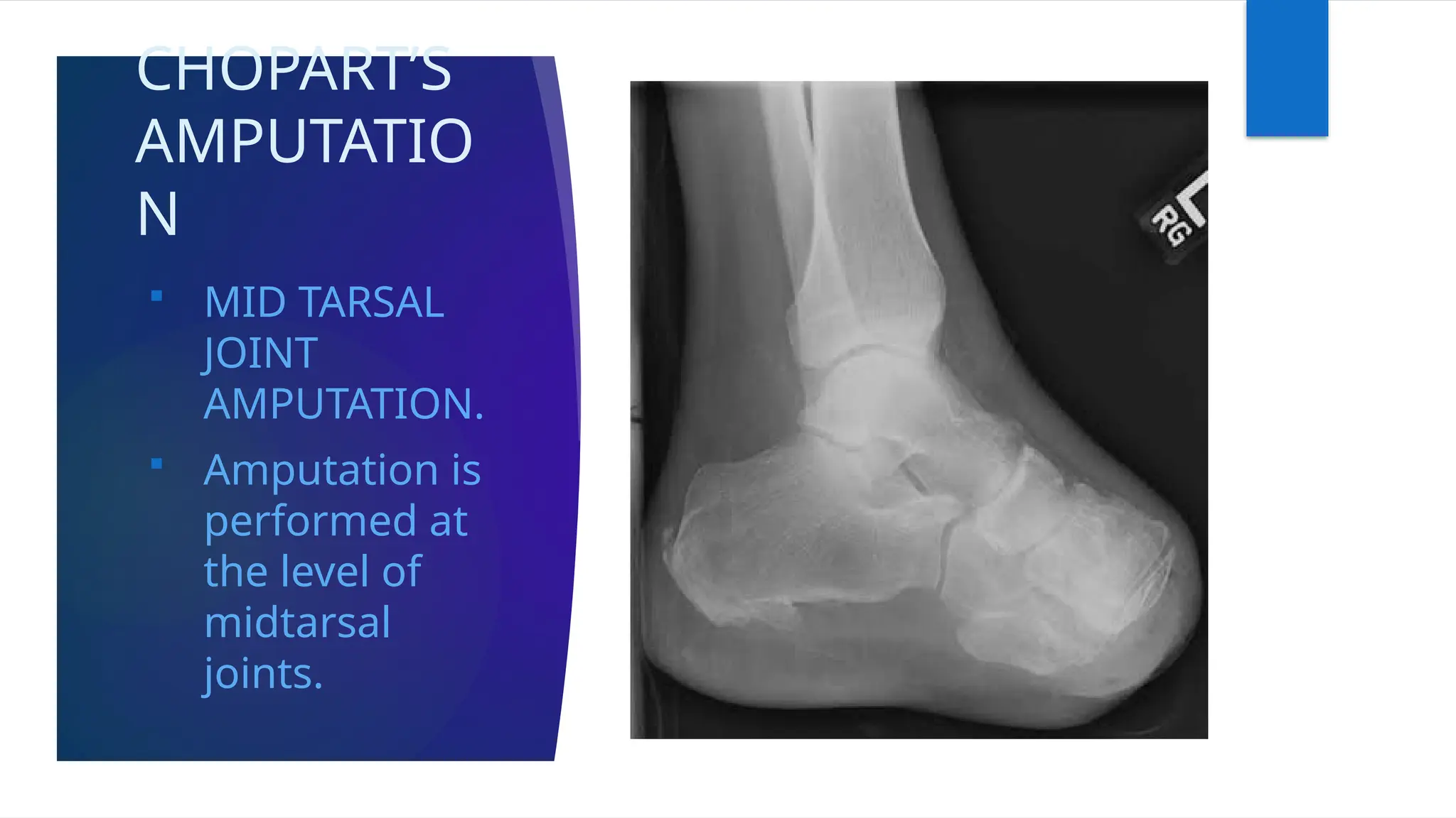 CHOPART’S
AMPUTATIO
N
 MID TARSAL
JOINT
AMPUTATION.
 Amputation is
performed at
the level of
midtarsal
joints.
 