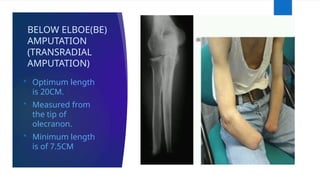 BELOW ELBOE(BE)
AMPUTATION
(TRANSRADIAL
AMPUTATION)
 Optimum length
is 20CM.
 Measured from
the tip of
olecranon.
 Minimum length
is of 7.5CM
 