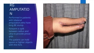 KRUKENBE
RG
AMPUTATIO
N
• Performed in patients
with bilateral
amputation,who have
long BE stump.
• Forearm is spilt
between radius and
ulna to provide pincer
grip.
• The patient can hold
spoon or lighter objects
with this fork.
 