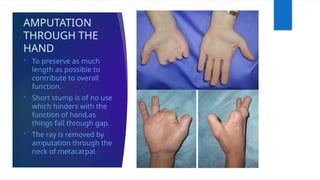 AMPUTATION
THROUGH THE
HAND
 To preserve as much
length as possible to
contribute to overall
function.
 Short stump is of no use
which hinders with the
function of hand,as
things fall through gap.
 The ray is removed by
amputation through the
neck of metacarpal.
 