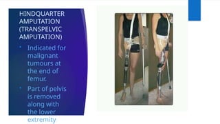HINDQUARTER
AMPUTATION
(TRANSPELVIC
AMPUTATION)
 Indicated for
malignant
tumours at
the end of
femur.
 Part of pelvis
is removed
along with
the lower
extremity.
 