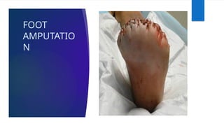 FOOT
AMPUTATIO
N
 