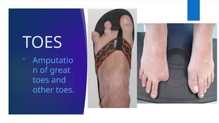 TOES
 Amputatio
n of great
toes and
other toes.
 