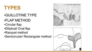 TYPES
•GUILLOTINE TYPE
•FLAP METHOD
•Circular flap
•Elliptical/ Oval flap
•Racquet method
•Semicircular/ Rectangular method
 