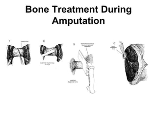 Comprehensive Guide to Limb Amputations and Exarticulations: Techniques ...