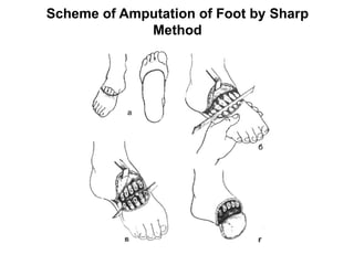 Comprehensive Guide to Limb Amputations and Exarticulations: Techniques ...