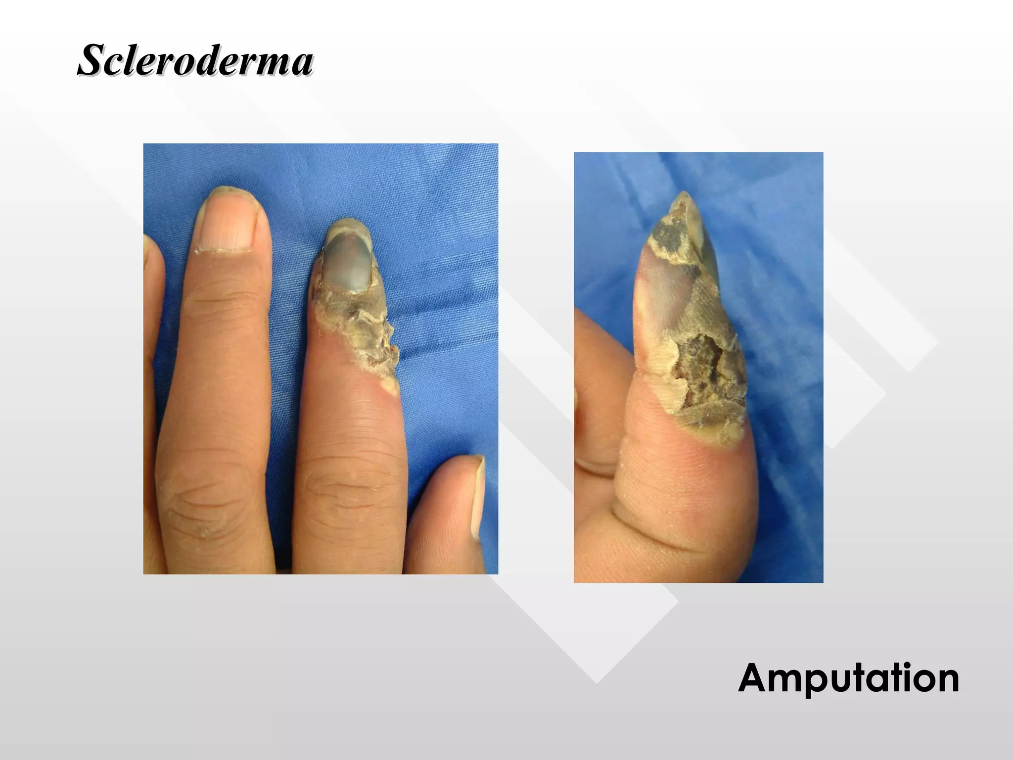 Scleroderma Amputation 