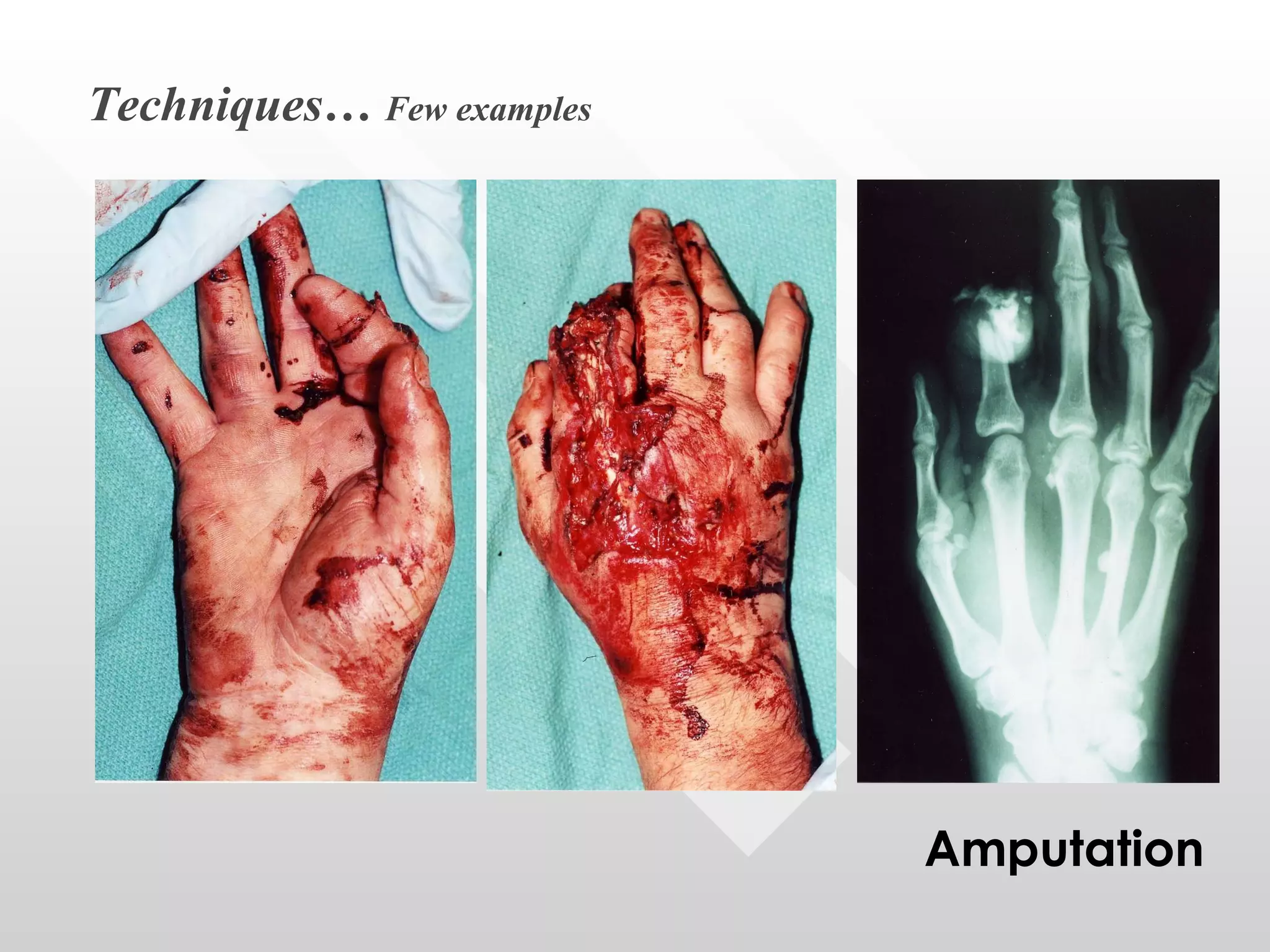 Techniques…  Few examples Amputation 