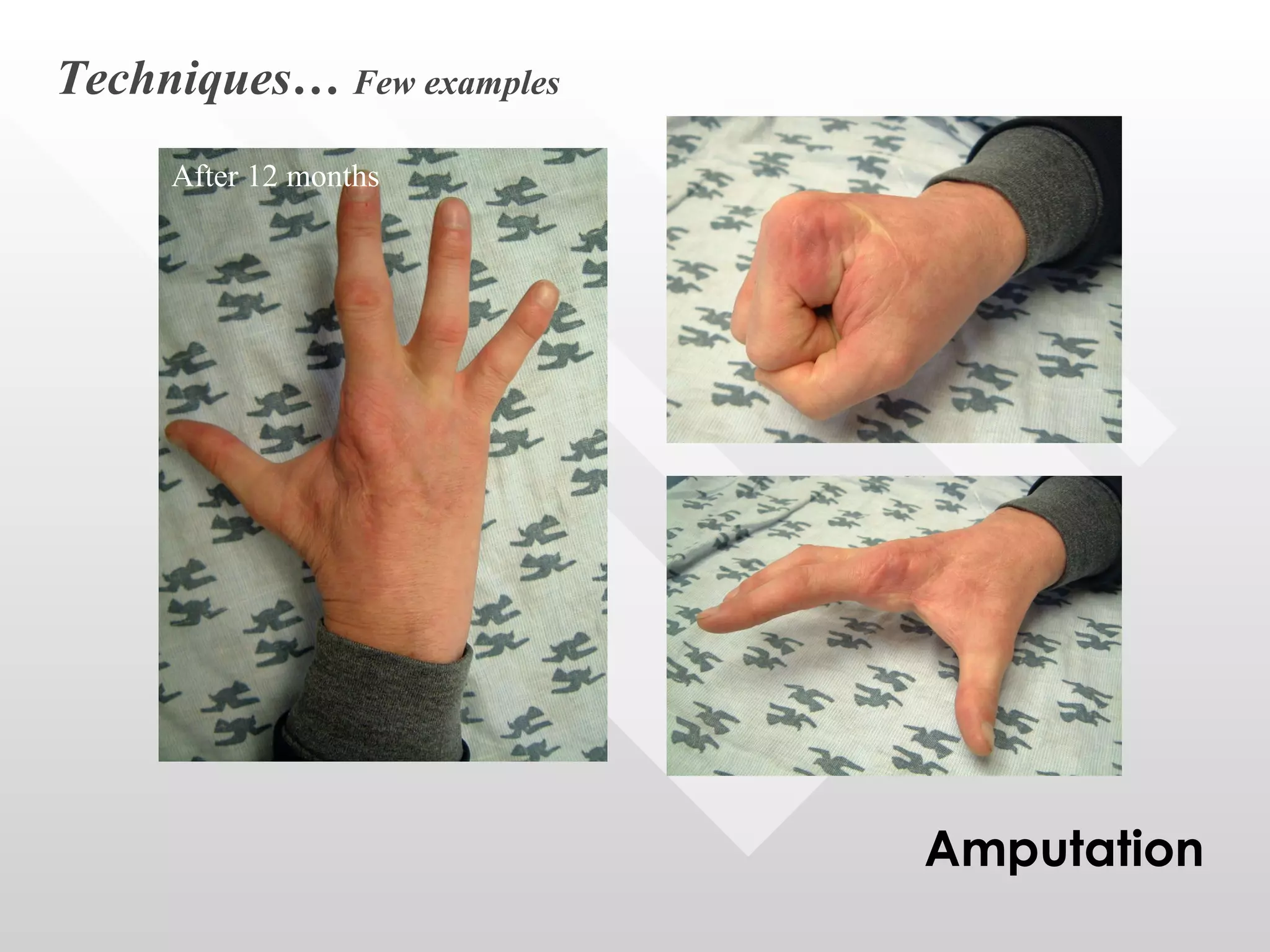 After 12 months Techniques…  Few examples Amputation 