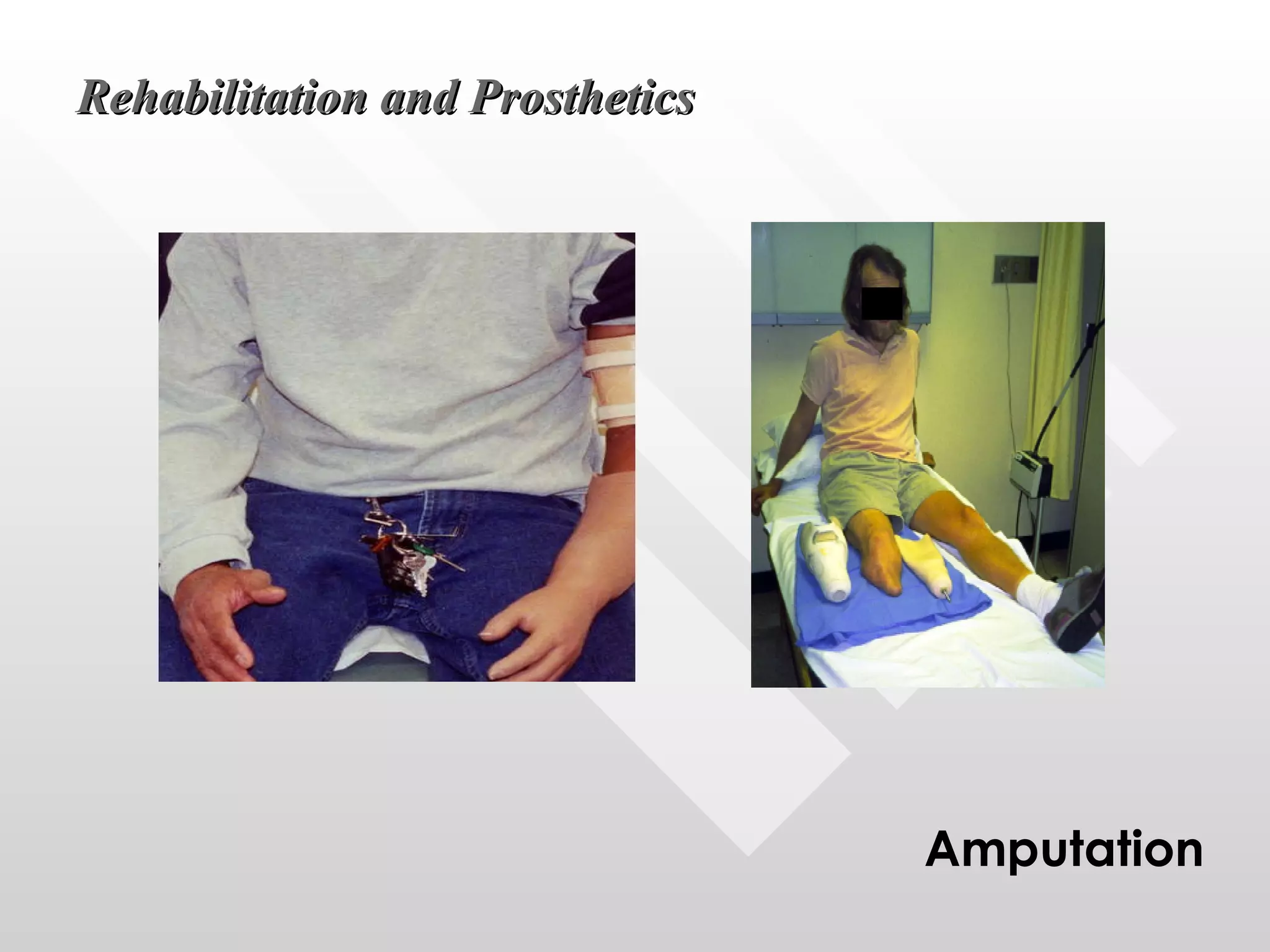 Rehabilitation and Prosthetics Amputation 