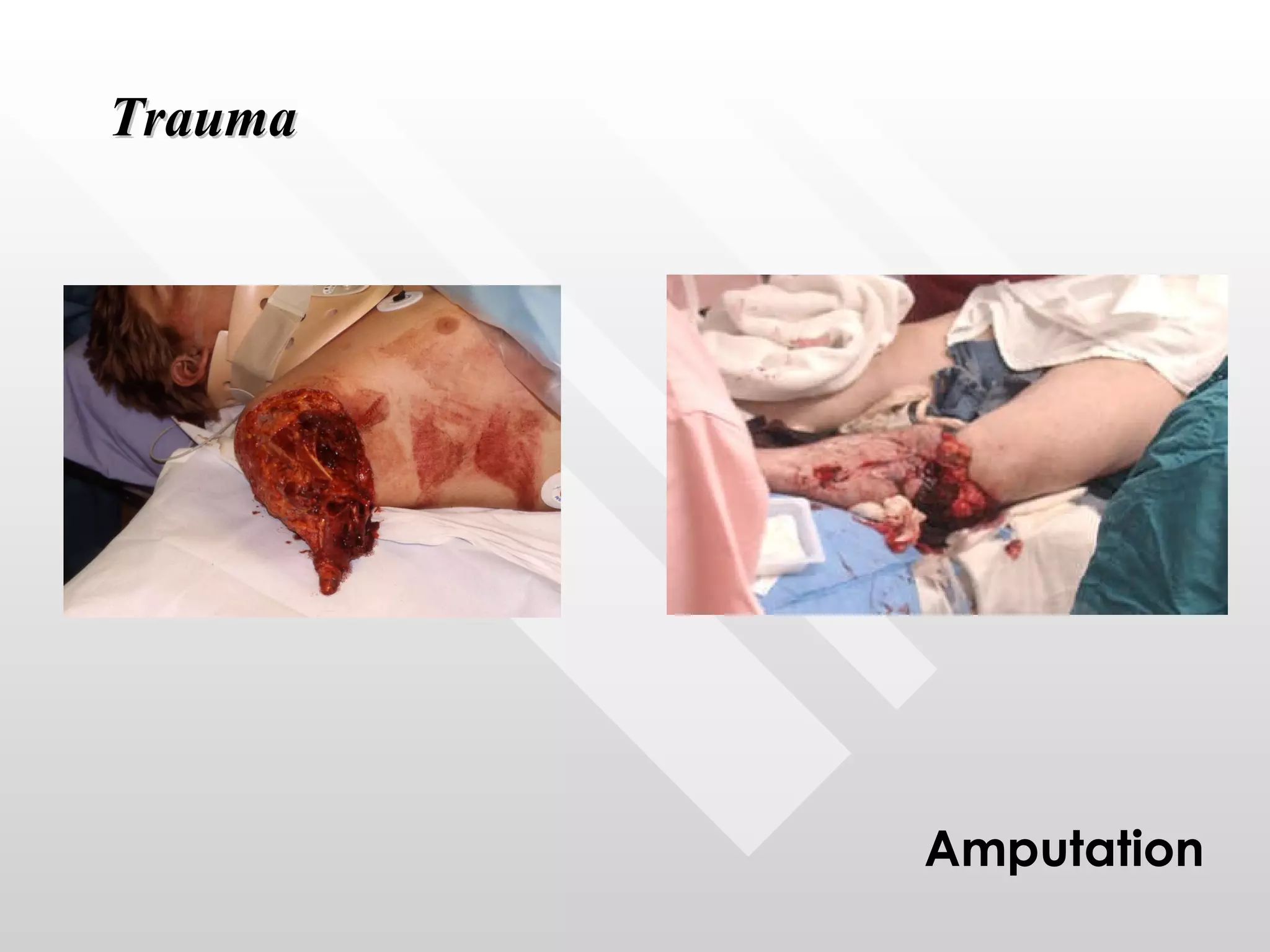 Trauma Amputation 