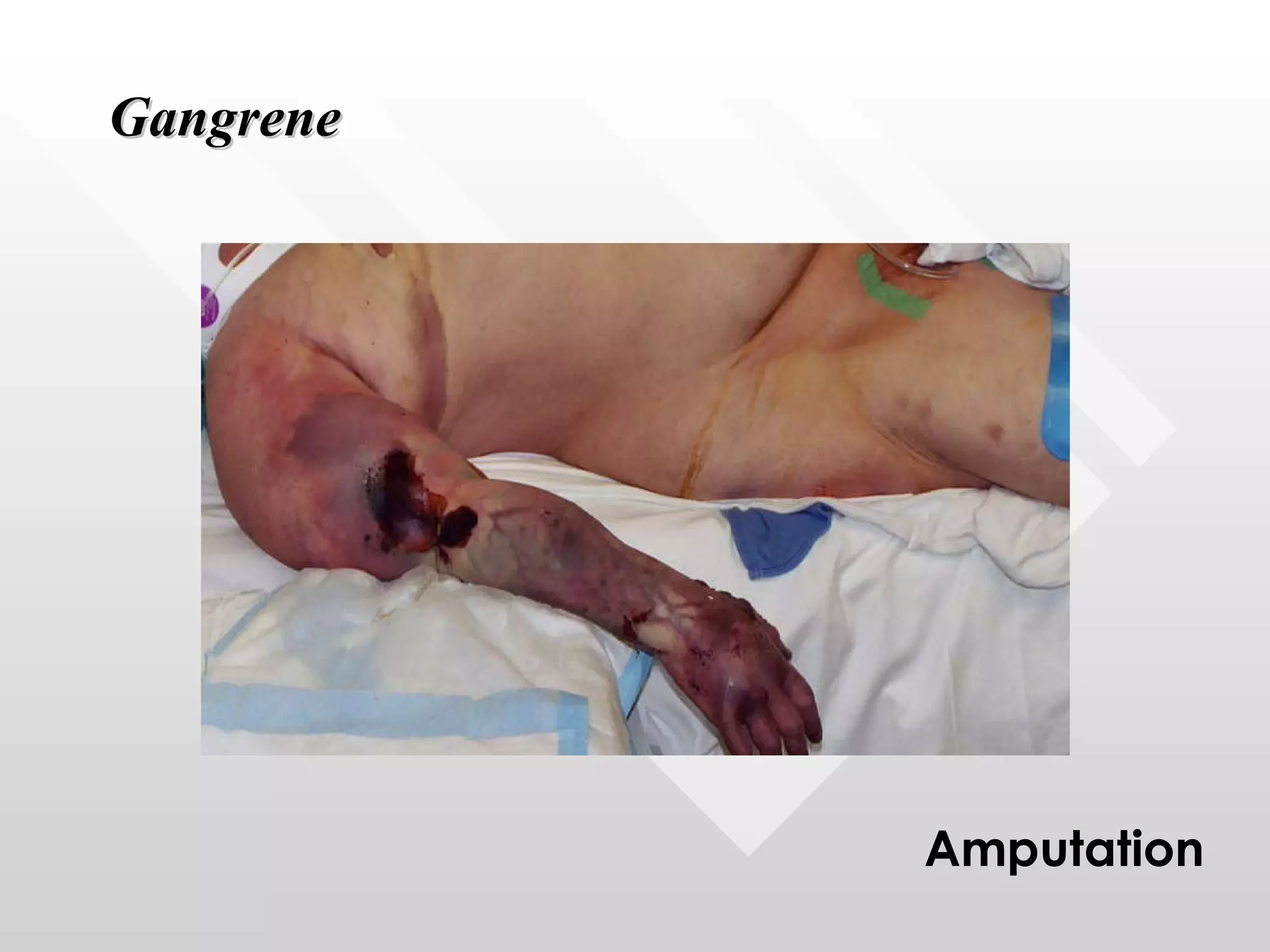 Gangrene Amputation 
