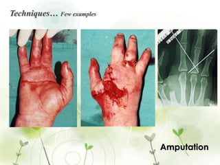 Osteomyodesis:  Anchoring opposing muscles group  with the bone trough drill hole and sutures.Principles of techniques…Nerve are divided proximal to the bone cut to ensure nerve end do not bear weight.Tibia is swan across the proposed level and front of the tibia is usually beveled and filed to create a smooth rounded contour.Fibula is cut 3 cm shorter. The main vessels are tied.The tourniquet is removed and every	bleeding point meticulously ligated.The skin is sutured carefully without tension.Suction drain is advised.Soft figure of eight bandage is given.