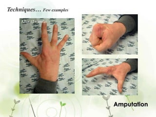 Amputation in Surgery | PPTX