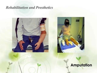 Amputation in Surgery | PPTX