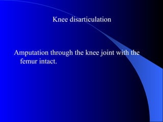 Amputation through the knee joint with the
femur intact.
Knee disarticulation
 