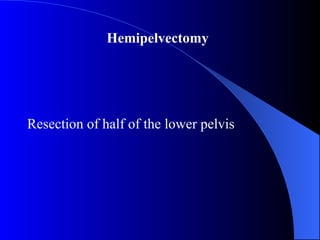 Resection of half of the lower pelvis
Hemipelvectomy
 