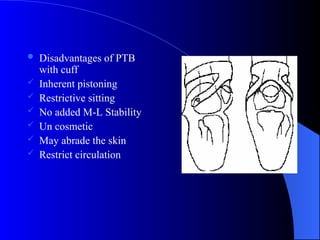  Disadvantages of PTB
with cuff
 Inherent pistoning
 Restrictive sitting
 No added M-L Stability
 Un cosmetic
 May abrade the skin
 Restrict circulation
 