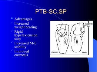 PTB-SC,SP
 Advantages
 Increased
weight bearing
 Rigid
hyperextension
stop
 Increased M-L
stability
 Improved
cosmesis
 