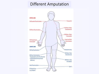 Different Amputation
 