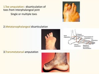 1.Toe amputation : disarticulation of
toes from Interphalangeal joint
Single or multiple toes
2.Metatarsophalangeal disarticulation
3.Transmetatarsal amputation
 