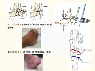 4. Lisfrank : at level of tarso-metatarsal
joint
5.Chopart’s : at level of midtarsal joint
 