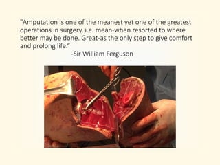 "Amputation is one of the meanest yet one of the greatest
operations in surgery, i.e. mean-when resorted to where
better may be done. Great-as the only step to give comfort
and prolong life.“
-Sir William Ferguson
 