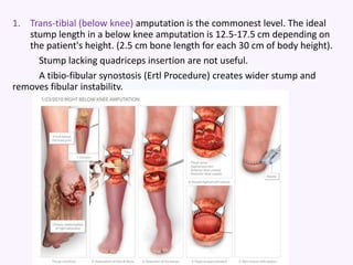 1. Trans-tibial (below knee) amputation is the commonest level. The ideal
stump length in a below knee amputation is 12.5-17.5 cm depending on
the patient's height. (2.5 cm bone length for each 30 cm of body height).
Stump lacking quadriceps insertion are not useful.
A tibio-fibular synostosis (Ertl Procedure) creates wider stump and
removes fibular instability.
 