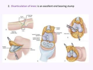 2. Disarticulation of knee: is an excellent end bearing stump
 