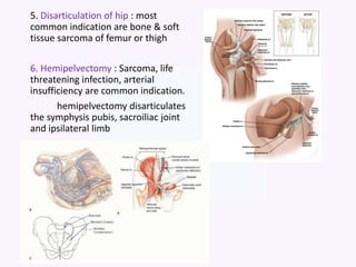 5. Disarticulation of hip : most
common indication are bone & soft
tissue sarcoma of femur or thigh
6. Hemipelvectomy : Sarcoma, life
threatening infection, arterial
insufficiency are common indication.
hemipelvectomy disarticulates
the symphysis pubis, sacroiliac joint
and ipsilateral limb
 