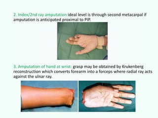 2. Index/2nd ray amputation ideal level is through second metacarpal if
amputation is anticipated proximal to PIP.
3. Amputation of hand at wrist: grasp may be obtained by Krukenberg
reconstruction which converts forearm into a forceps where radial ray acts
against the ulnar ray.
 