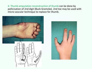 4. Thumb amputation reconstruction of thumb can be done by
pollicisation of 2nd digit (Buck-Gramcko). 2nd toe may be used with
micro-vascular technique to replace for thumb.
 