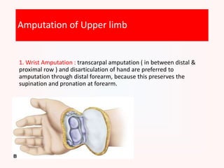 Amputation of Upper limb
1. Wrist Amputation : transcarpal amputation ( in between distal &
proximal row ) and disarticulation of hand are preferred to
amputation through distal forearm, because this preserves the
supination and pronation at forearm.
 