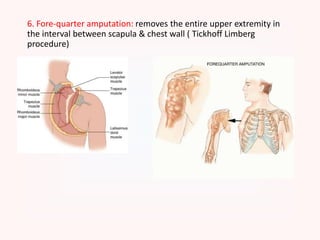 6. Fore-quarter amputation: removes the entire upper extremity in
the interval between scapula & chest wall ( Tickhoff Limberg
procedure)
 
